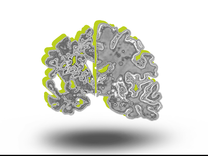 Brain with Alzheimer's disease