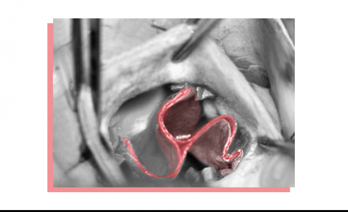 Heart surgery: Ozaki procedure