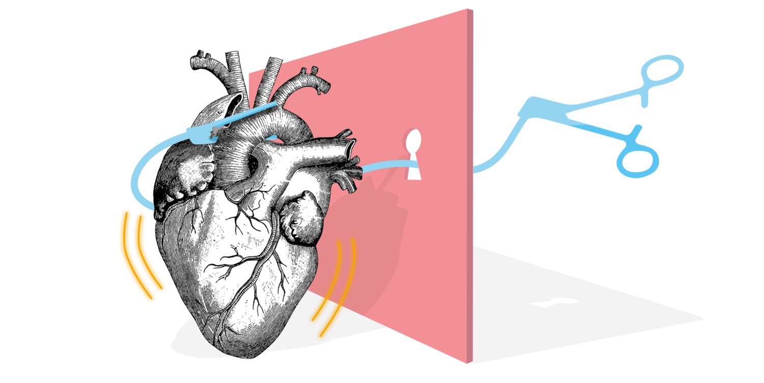 Symbolbild Minimalinvasive Herzchirurgie: Holzschnitt-Herz, Schlüsselloch, Intrathorakale Klemme / Cosgrove